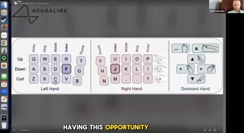 Neuralink-beteg 141 szót/perc sebességgel gépel gondolattal